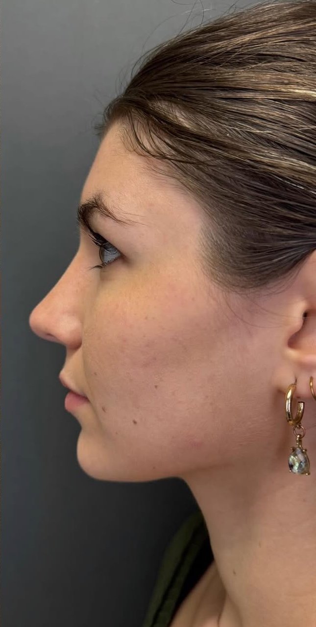 Cosmetic Rhinoplasty after