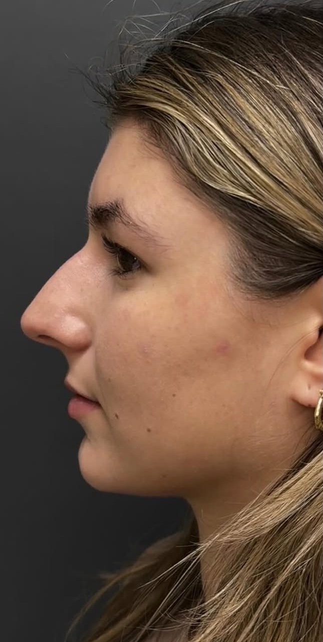 Cosmetic Rhinoplasty before