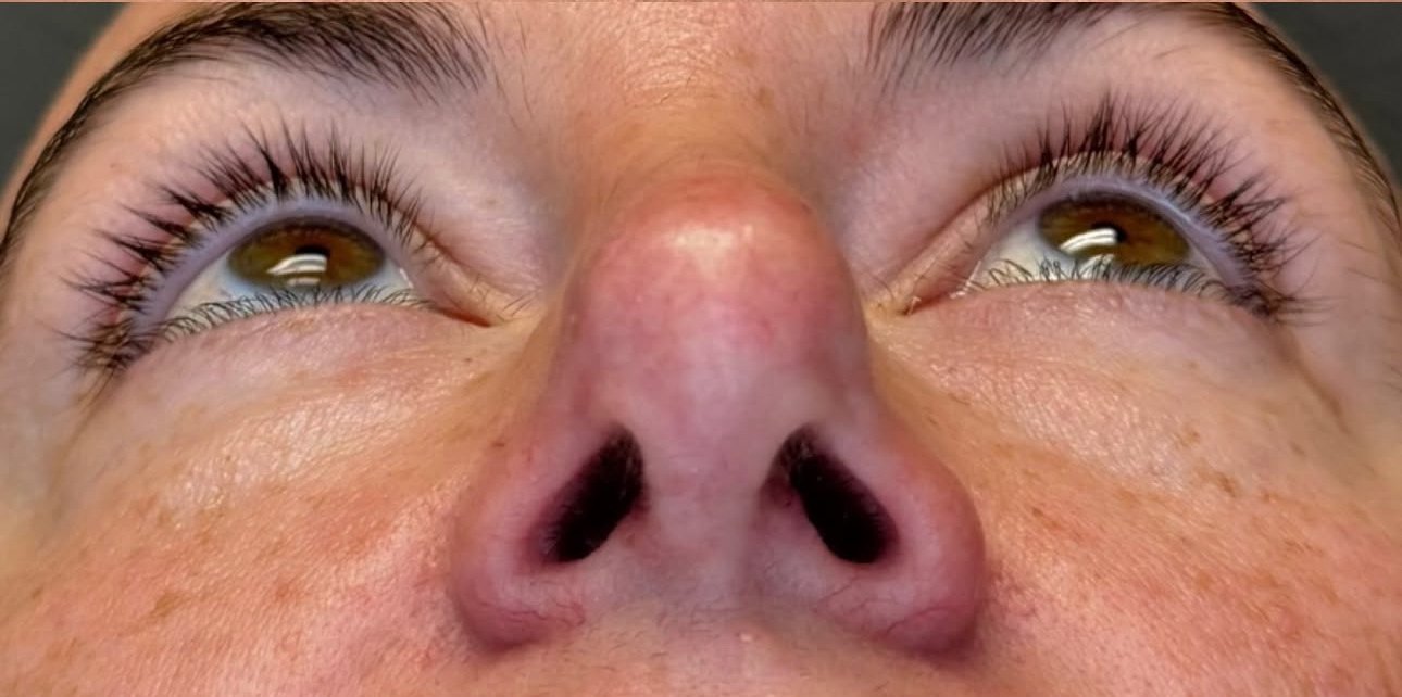 Functional Rhinoplasty after