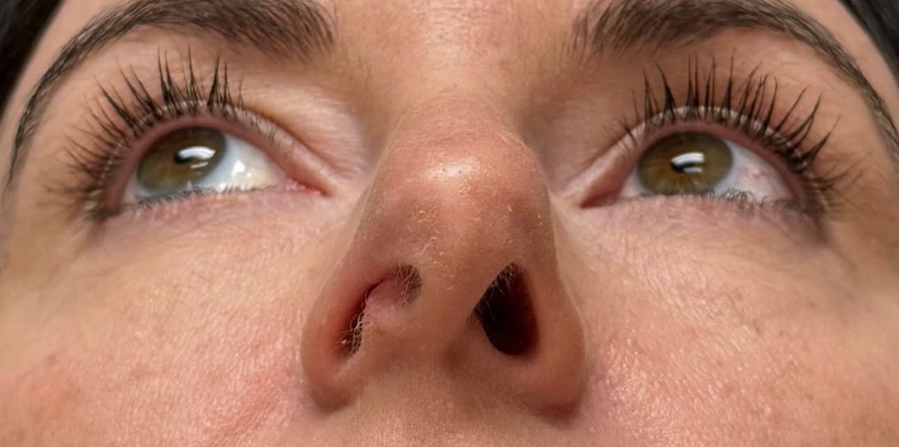 Functional Rhinoplasty before