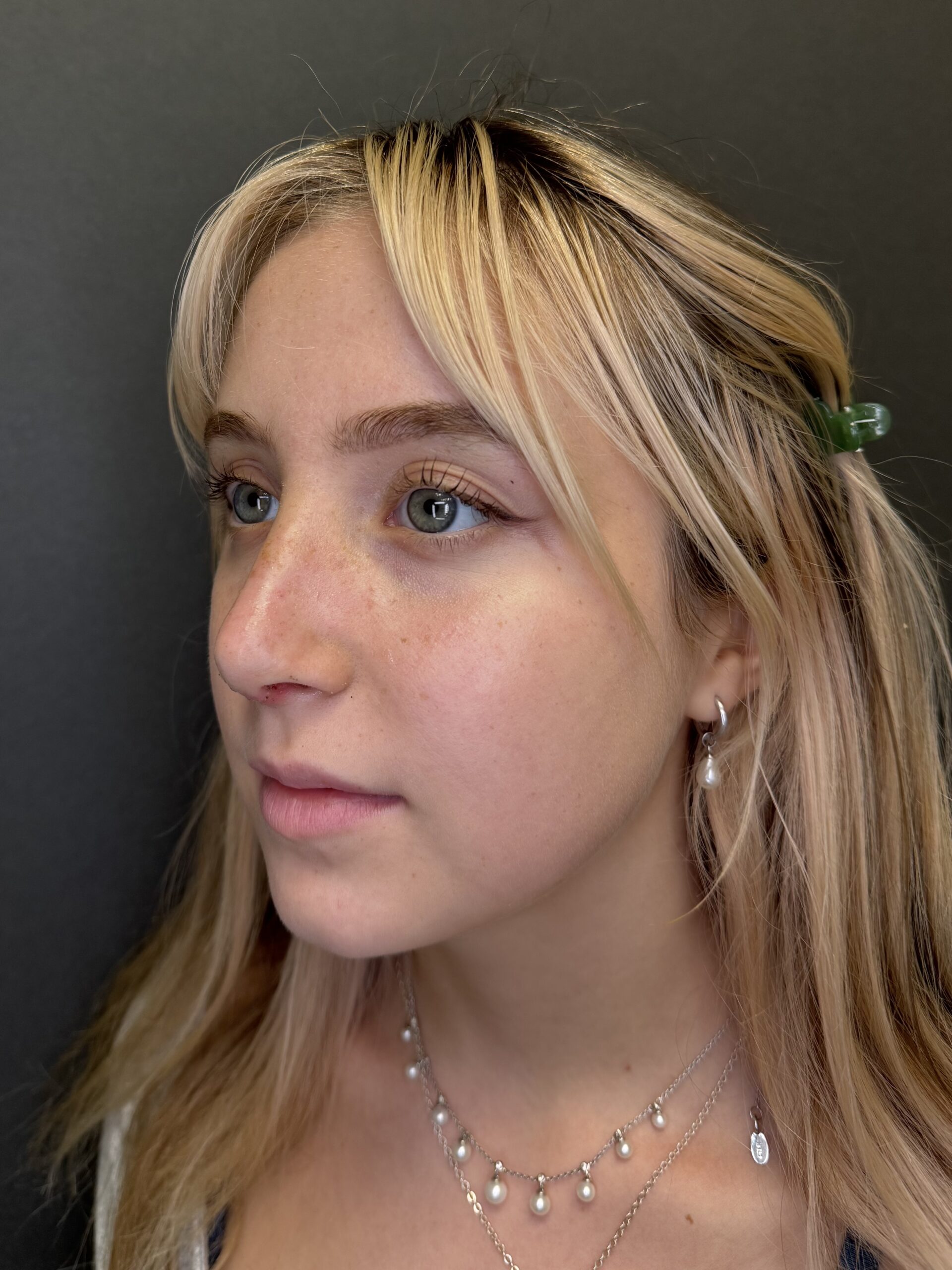 Patient days after piezoelectric rhinoplasty — Bay Aesthetics Palo Alto