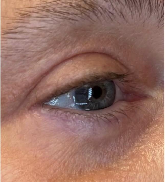 Lower Blepharoplasty after