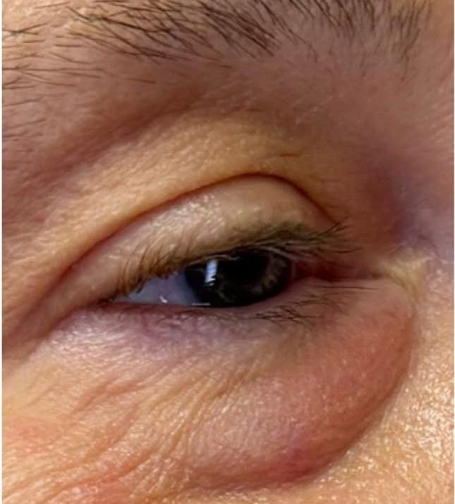 Lower Blepharoplasty before