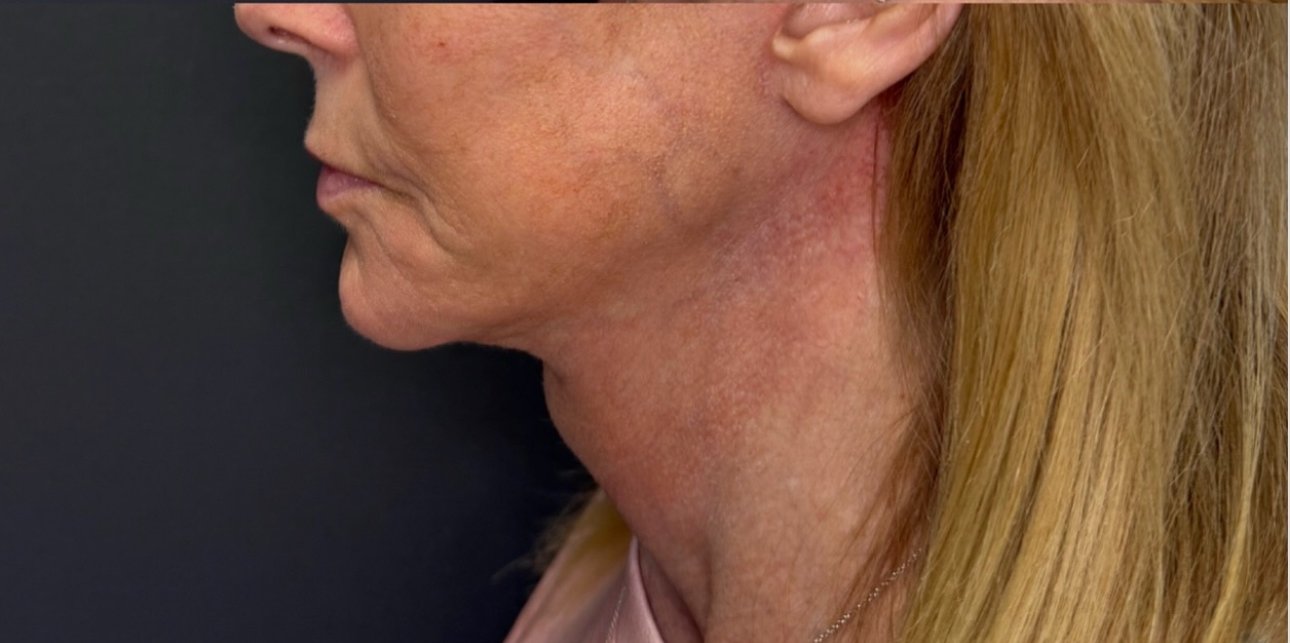 Neck Lift after