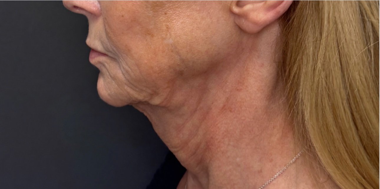 Neck Lift before