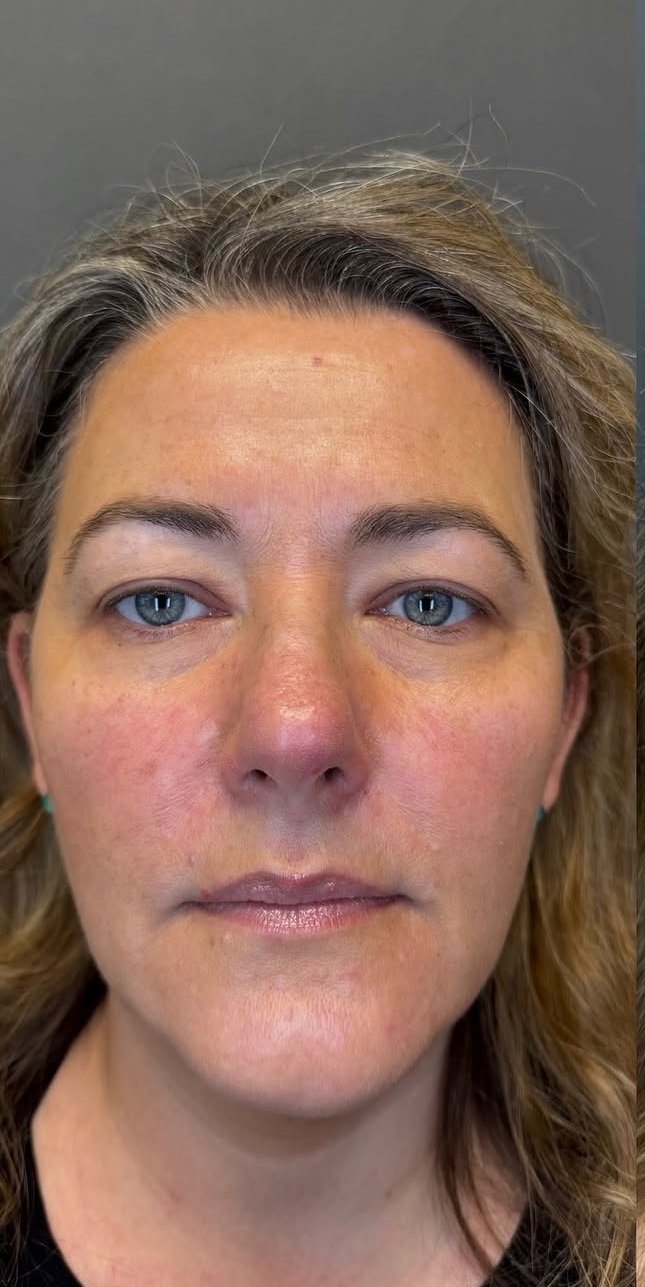 Upper Blepharoplasty before