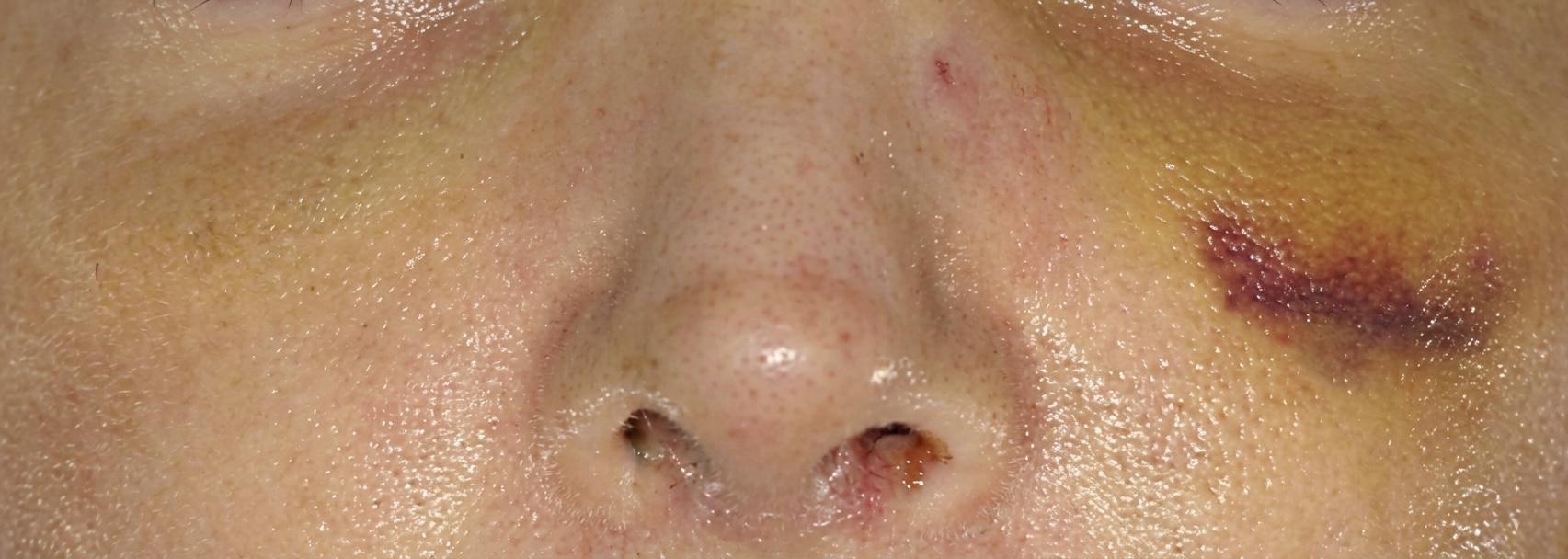 Piezo vs chisel bruising comparison