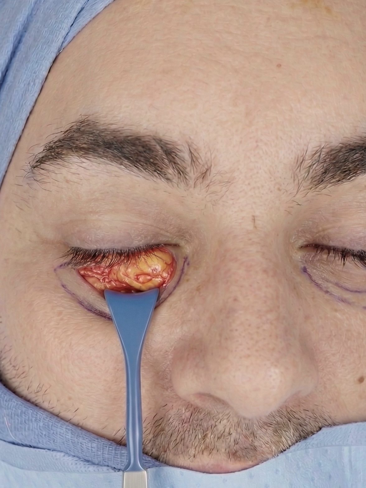 Demars eyelid retractor exposing herniated orbital fat through transconjunctival incision — Bay Aesthetics, Dr. Sean Hashemi