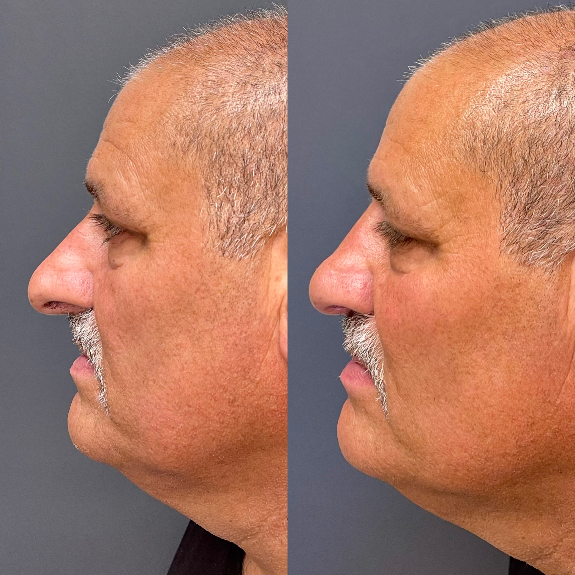 Male rhinoplasty before and after — Bay Aesthetics