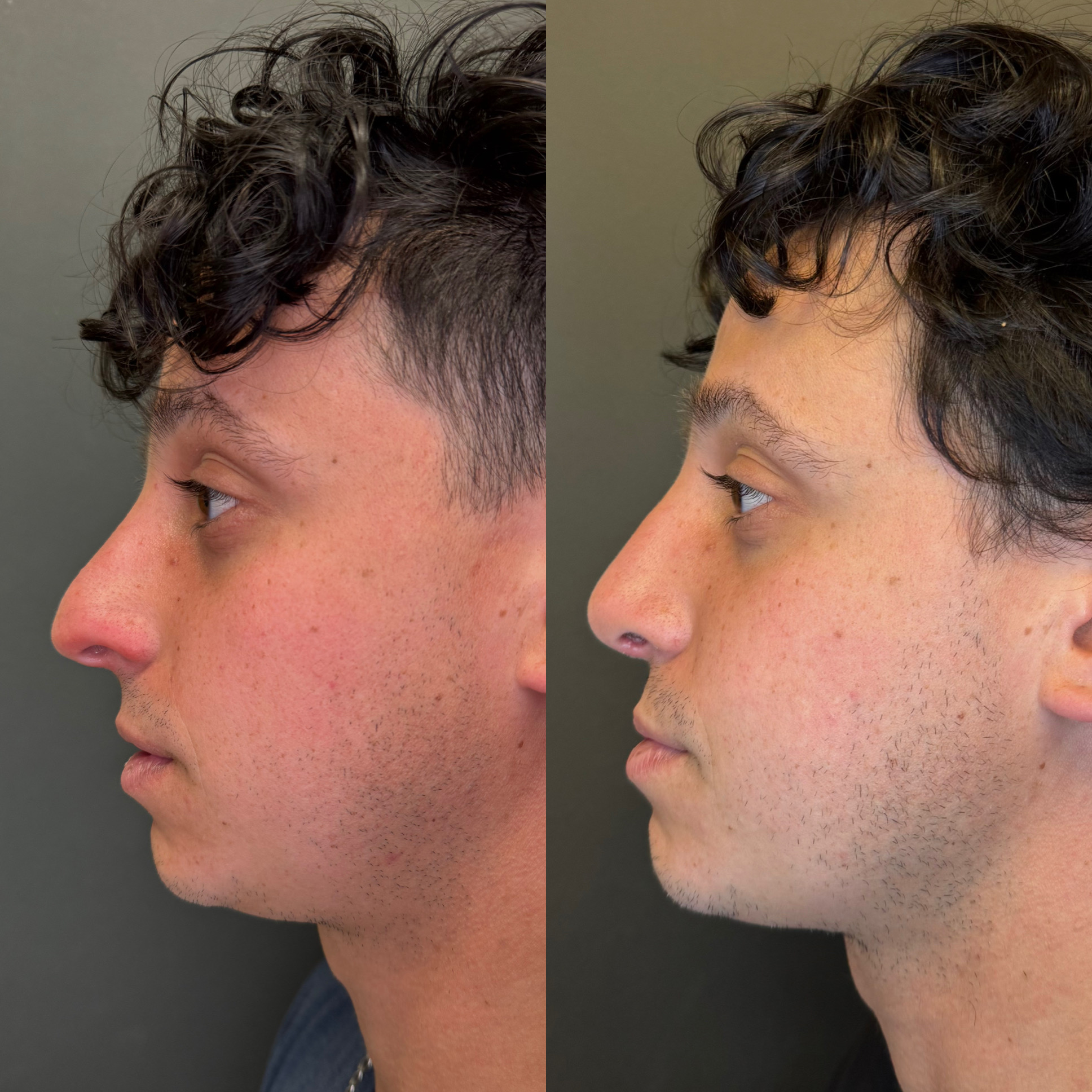 Male rhinoplasty before and after — Bay Aesthetics