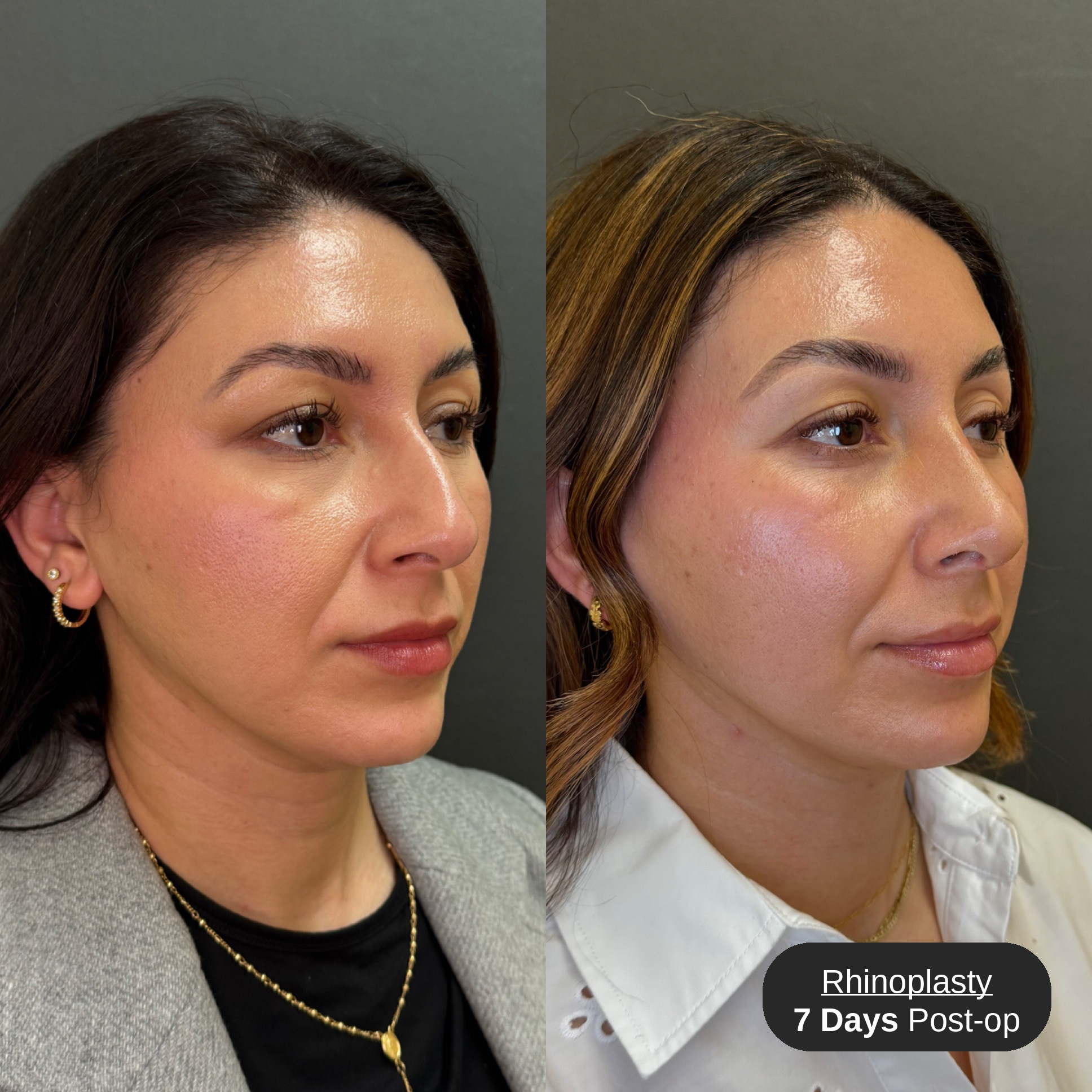 Rhinoplasty before and after, three-quarter view, patient 2, Bay Aesthetics, Palo Alto