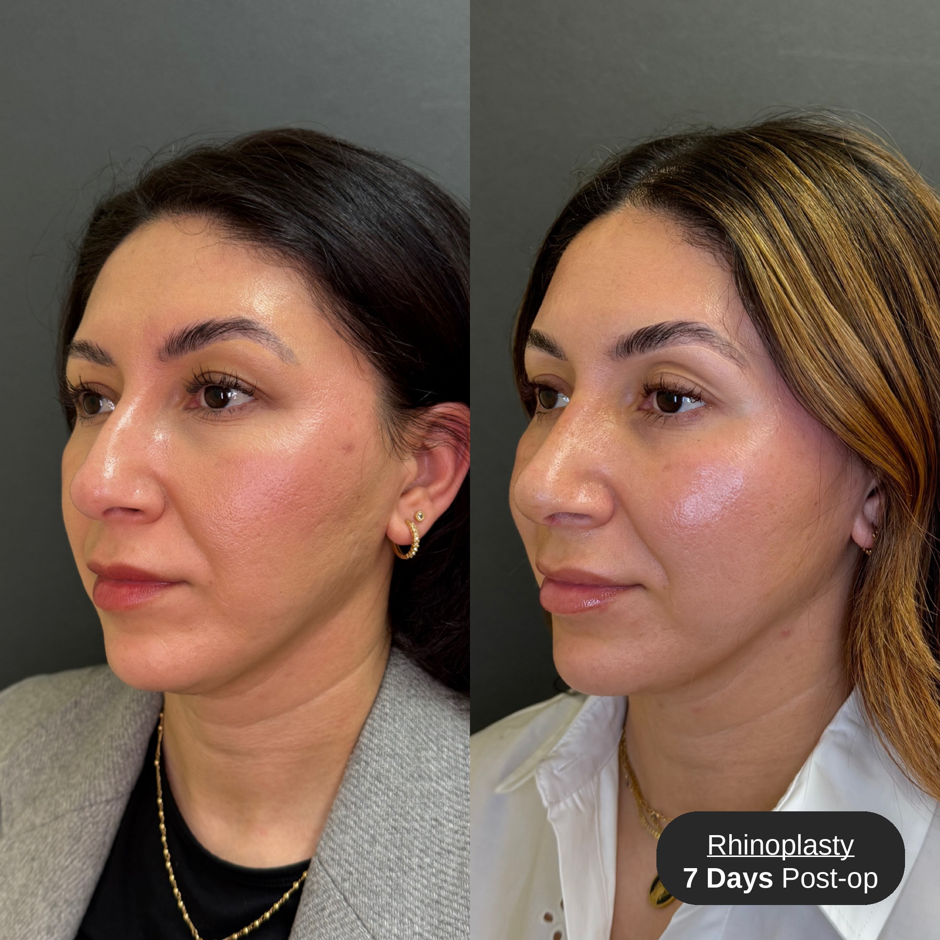 Rhinoplasty before and after, opposite three-quarter view, patient 2, Bay Aesthetics, Palo Alto