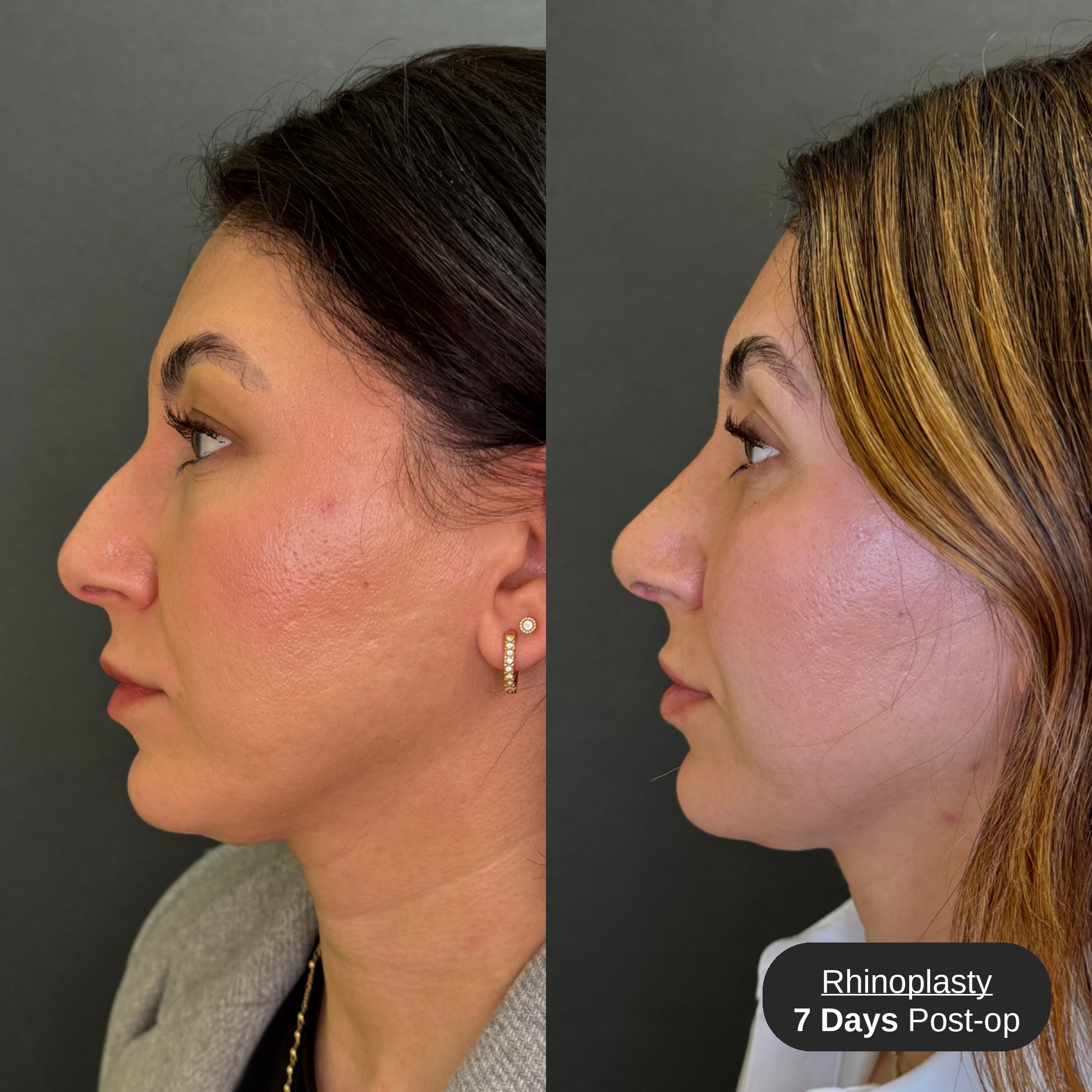 Rhinoplasty before and after, opposite profile view, patient 2, Bay Aesthetics, Palo Alto