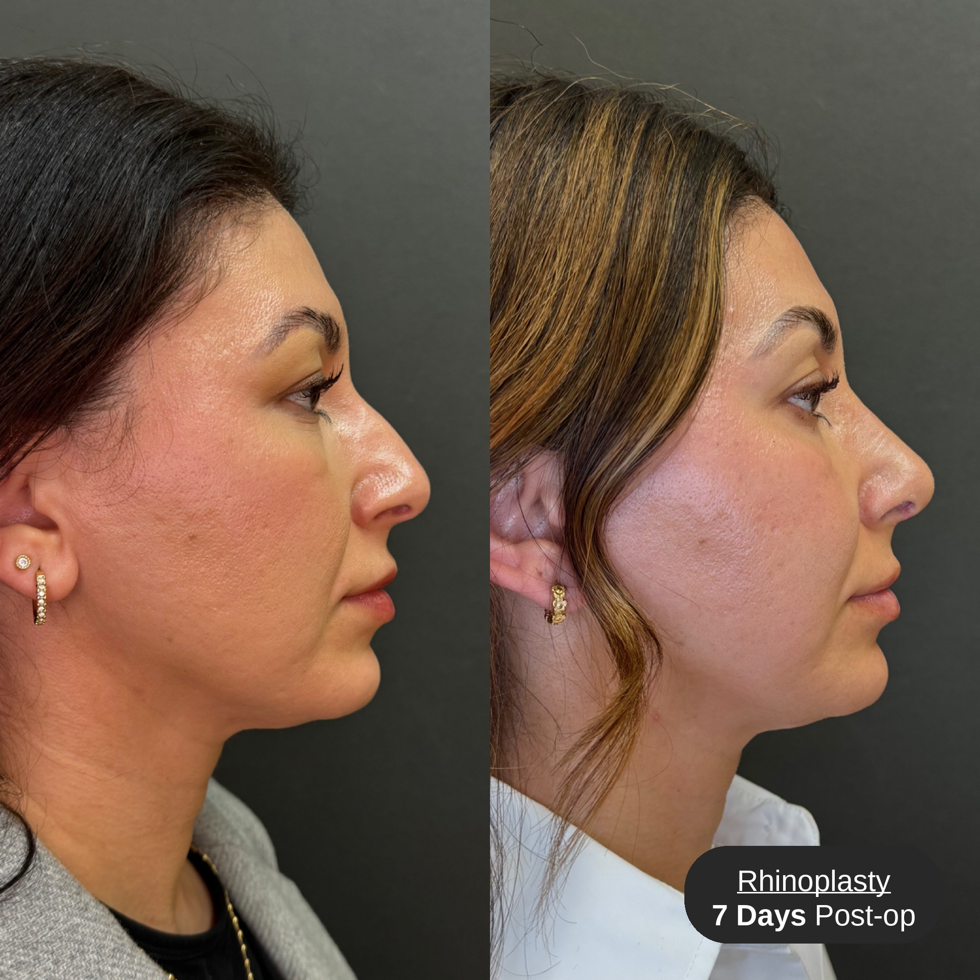 Rhinoplasty before and after, profile view, patient 2, Bay Aesthetics, Palo Alto