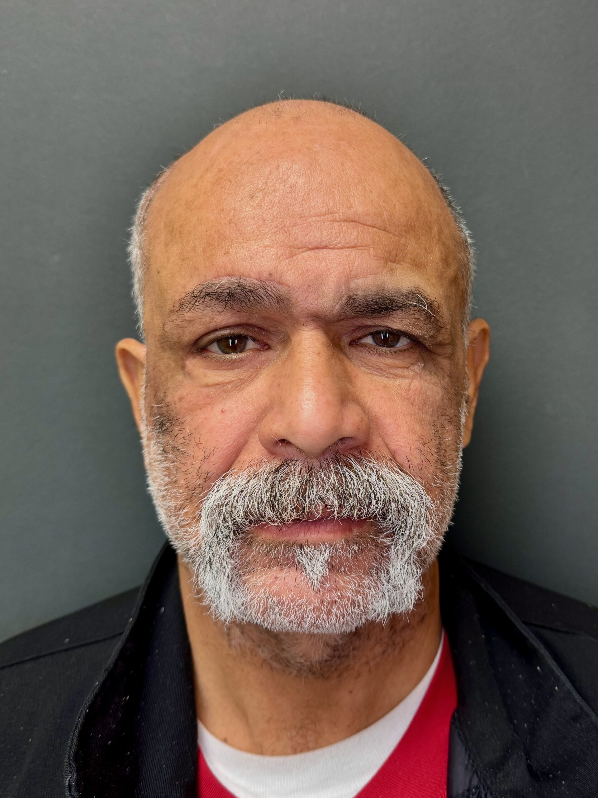 Healed result after reconstruction of the face, front view, patient 5, Bay Aesthetics, Palo Alto