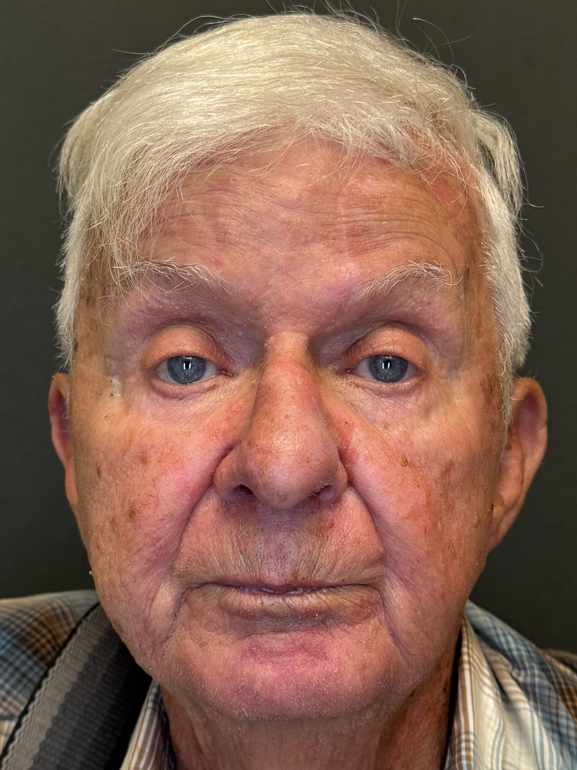 Healed result after reconstruction of the nose, front view, patient 4, Bay Aesthetics, Palo Alto