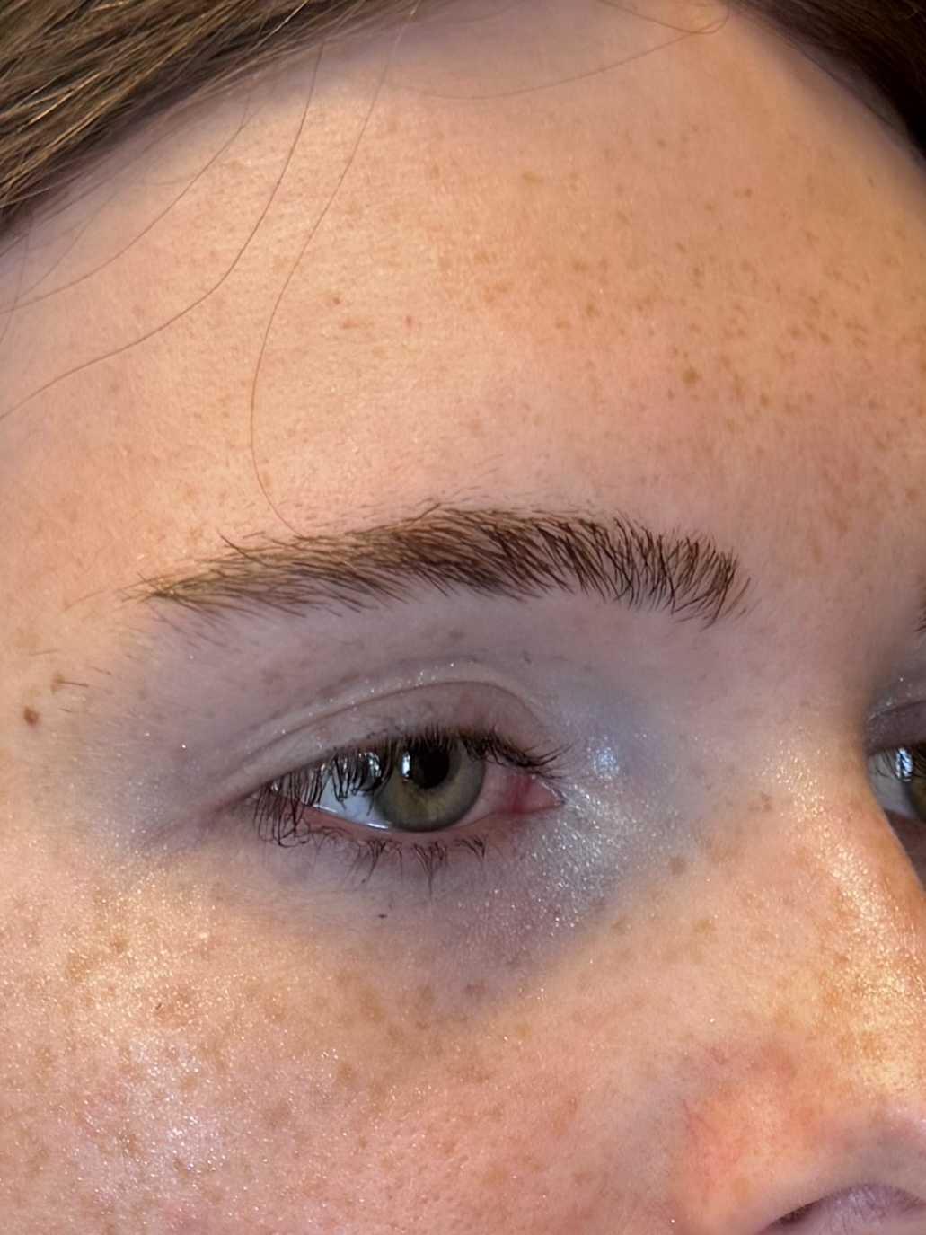 Brow lift, close view of the brow and eyelid after surgery, patient 1, Bay Aesthetics, Palo Alto