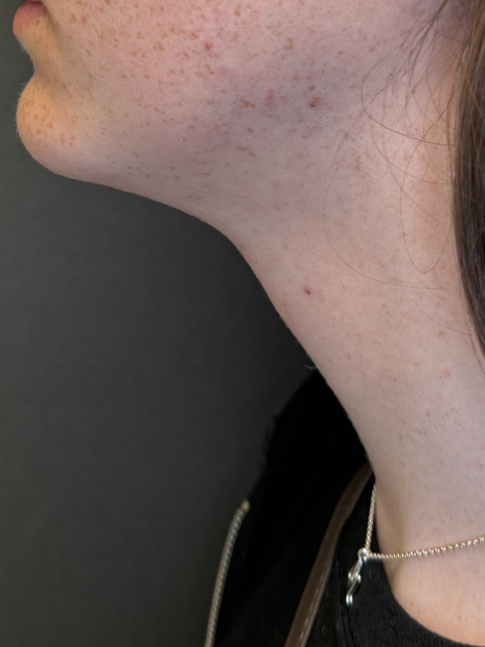 Cosmetic facial surgery, profile view of the jawline and neck after surgery, patient 2, Bay Aesthetics, Palo Alto