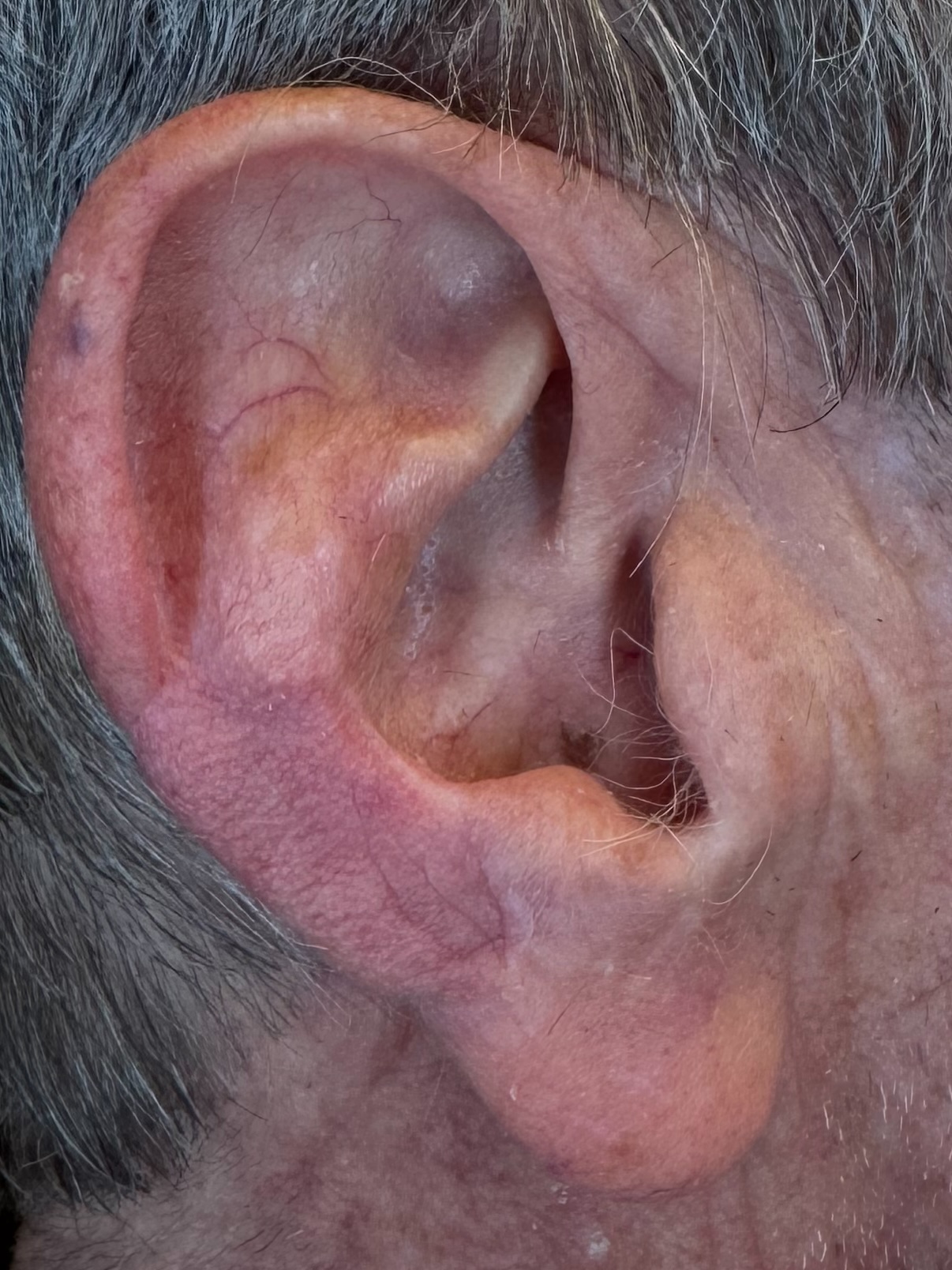 Healed result after reconstruction of the ear, close view of the ear, patient 2, Bay Aesthetics, Palo Alto