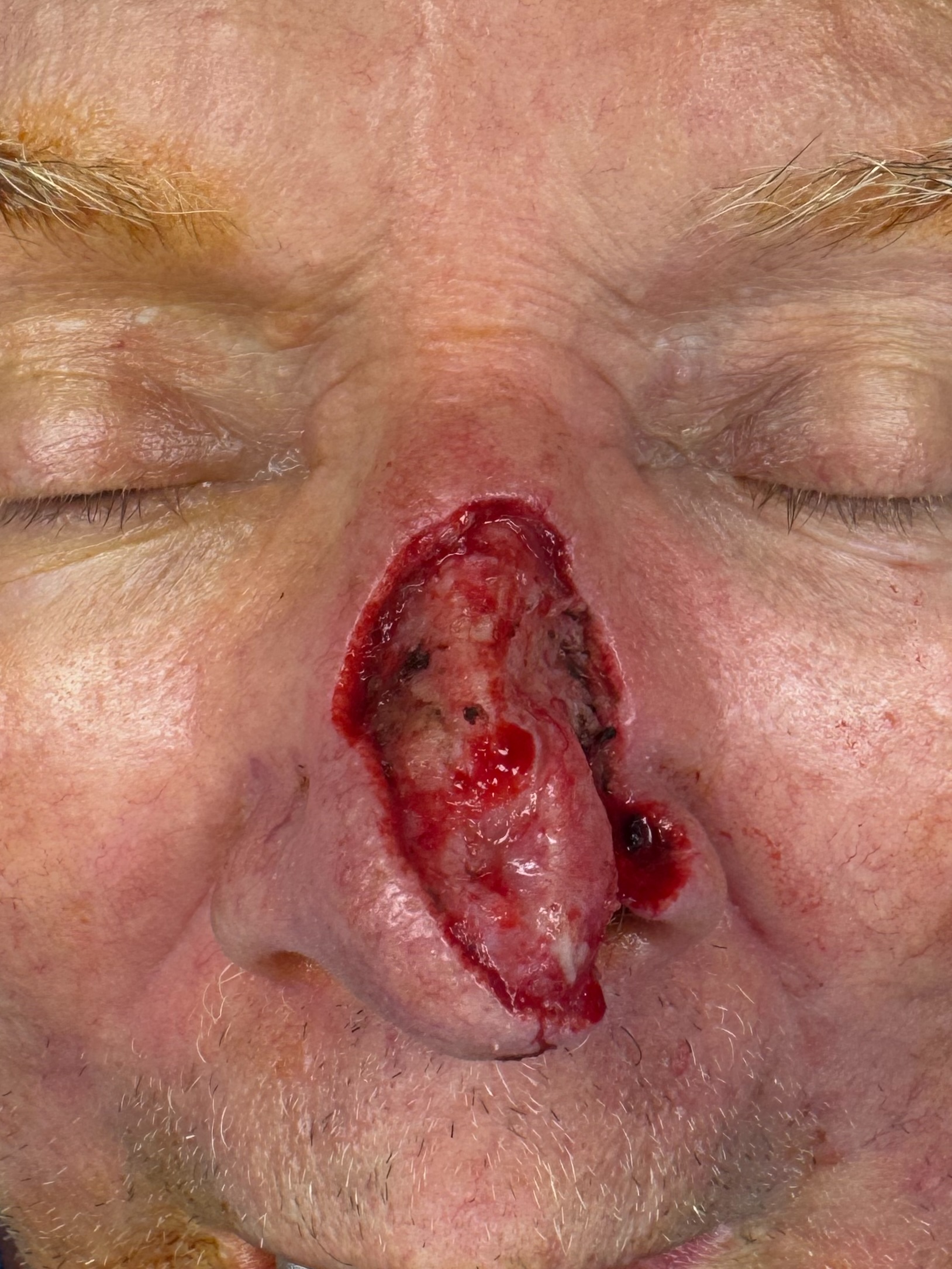 Surgical defect of the nose before reconstruction, front view, patient 4, Bay Aesthetics, Palo Alto