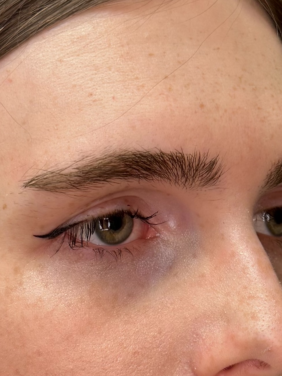 Brow lift, close view of the brow and eyelid before surgery, patient 1, Bay Aesthetics, Palo Alto