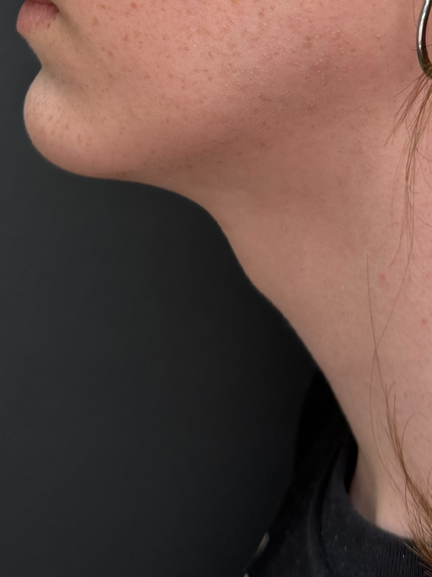 Cosmetic facial surgery, profile view of the jawline and neck before surgery, patient 2, Bay Aesthetics, Palo Alto