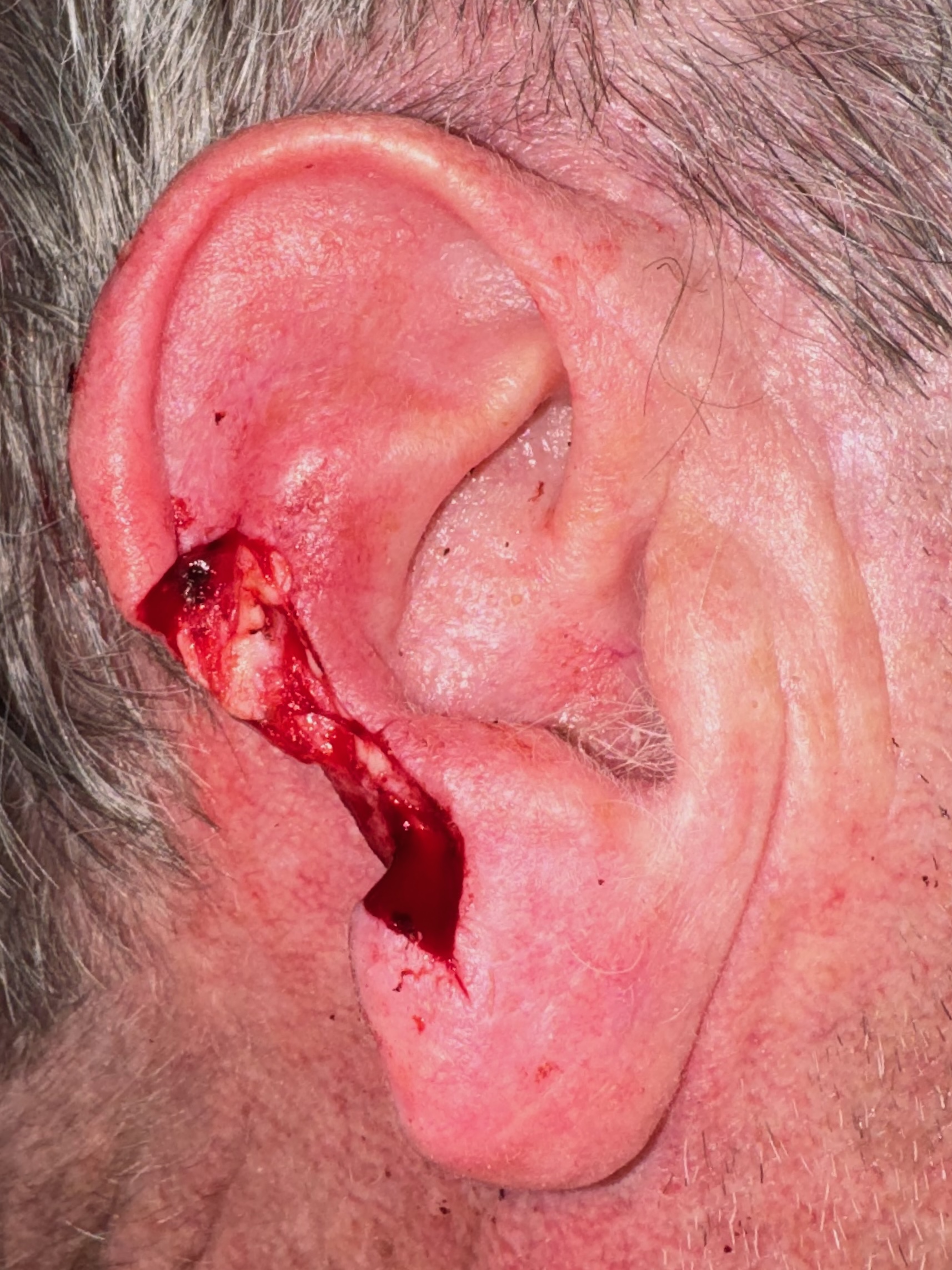 Surgical defect of the ear before reconstruction, close view of the ear, patient 2, Bay Aesthetics, Palo Alto