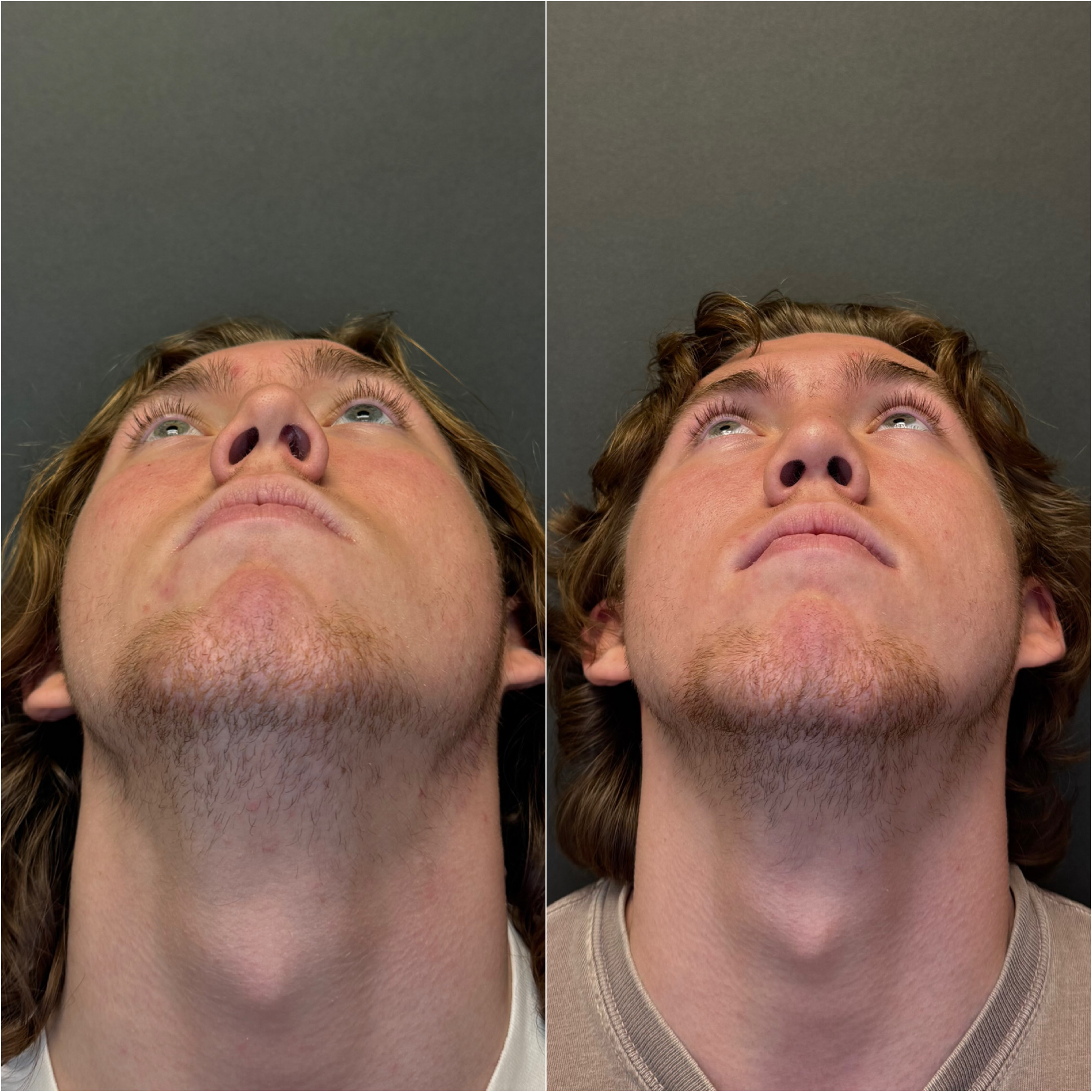 Functional rhinoplasty before and after, base view, Dr. Sean Hashemi, Palo Alto