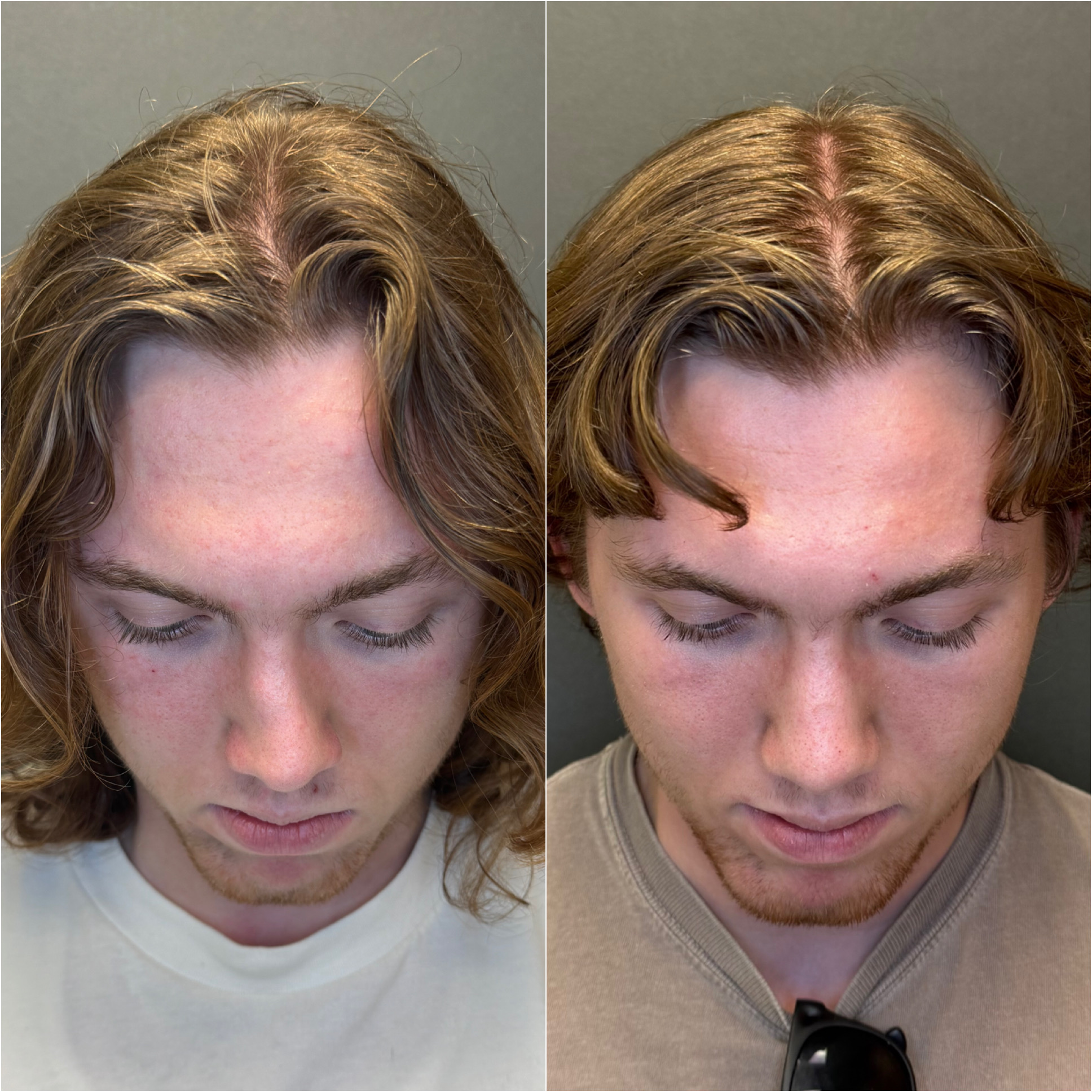 Functional rhinoplasty before and after, dorsal view from above, Dr. Sean Hashemi, Palo Alto