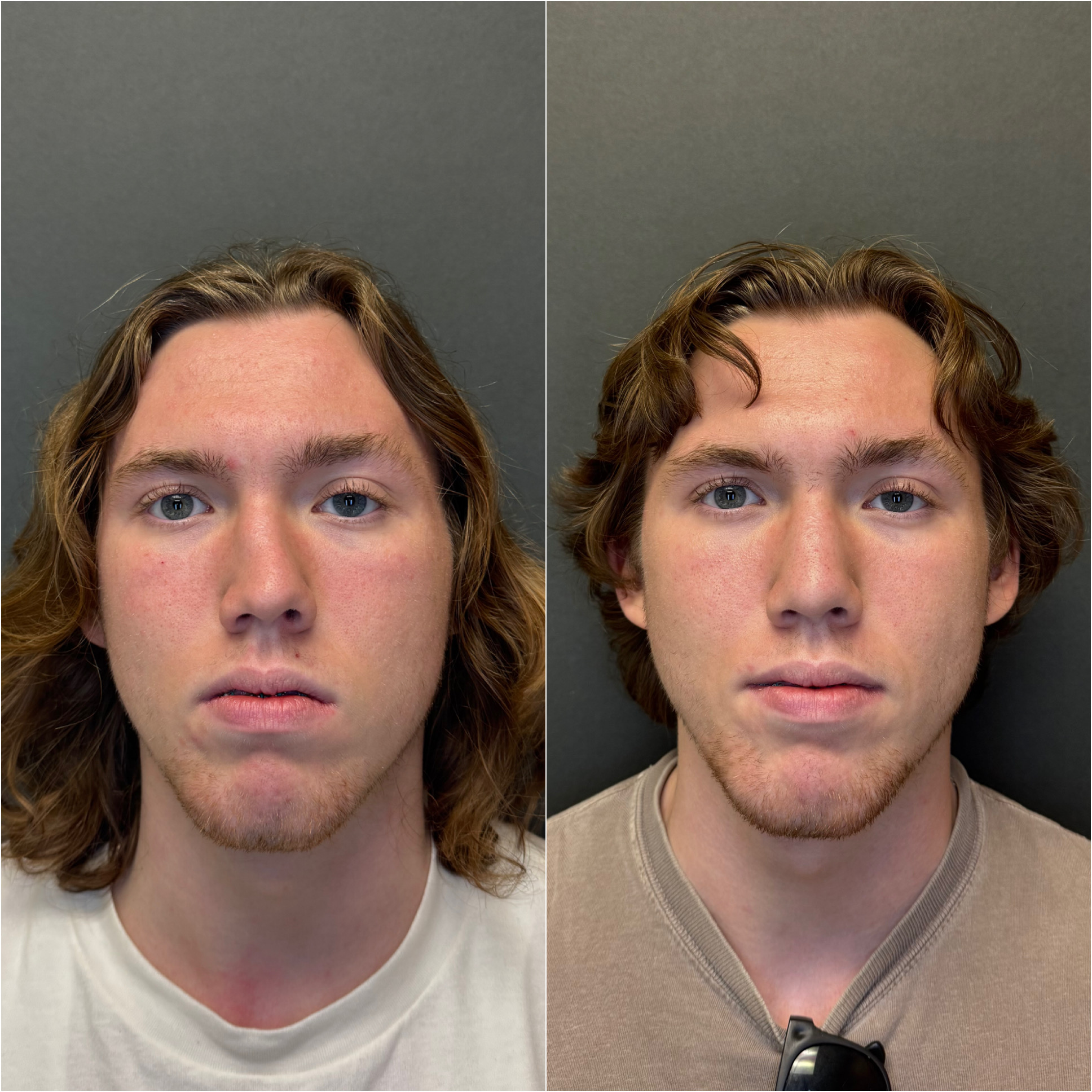 Functional rhinoplasty before and after, front view, Dr. Sean Hashemi, Palo Alto