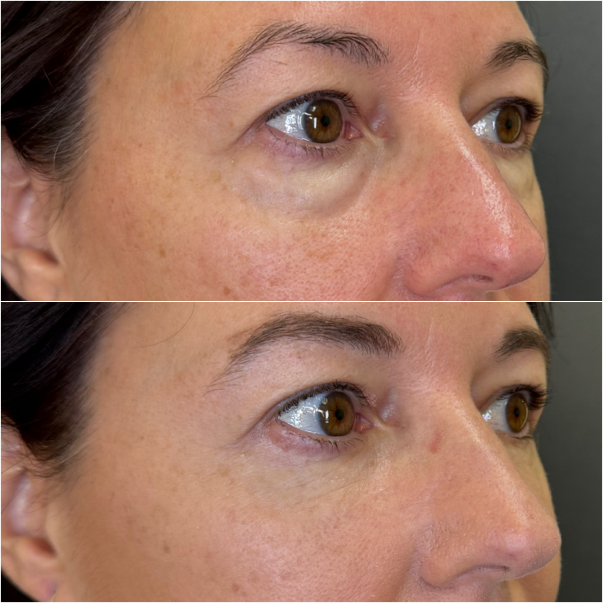 Lower eyelid blepharoplasty before and after, stacked comparison, Bay Aesthetics, Palo Alto